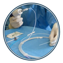 Tratamiento mínimamente invasivo que permite corregir problemas de circulación desde el interior de las arterias y venas, sin necesidad de cirugías abiertas. Indicado para obstrucciones, aneurismas, fístulas arterio venosas. Tiene como ventajas incisiones pequeñas, menor dolor, menor riesgo y una recuperación mucho más rápida.