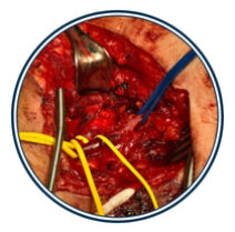 Procedimientos especializados para tratar enfermedades que afectan la circulación sanguínea en arterias y venas. Permite resolver obstrucciones, insuficiencia venosa, trauma vascular y otros trastornos vasculares. Su objetivo es restablecer el flujo sanguíneo, aliviar síntomas y prevenir complicaciones mayores.