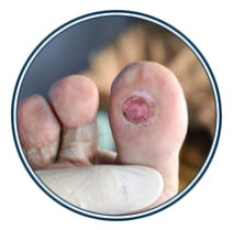 El manejo avanzado del pie diabético es un enfoque integral orientado a tratar infecciones, úlceras y alteraciones circulatorias mediante diagnóstico preciso y terapias especializadas que favorecen la cicatrización y controlan la infección, con el objetivo de preservar la extremidad y mantener su funcionalidad.